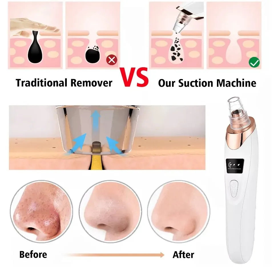 Prime 5-in-1 Rechargeable Blackhead Remover Machine